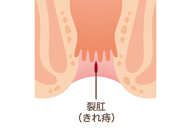 裂肛（急性・慢性）