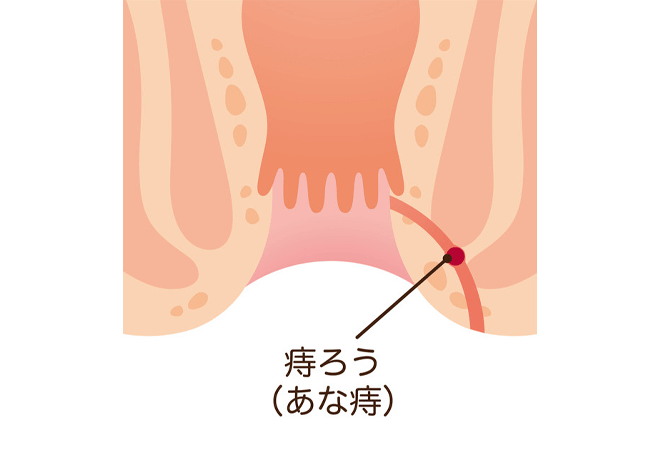 痔瘻（痔ろう・あな痔）